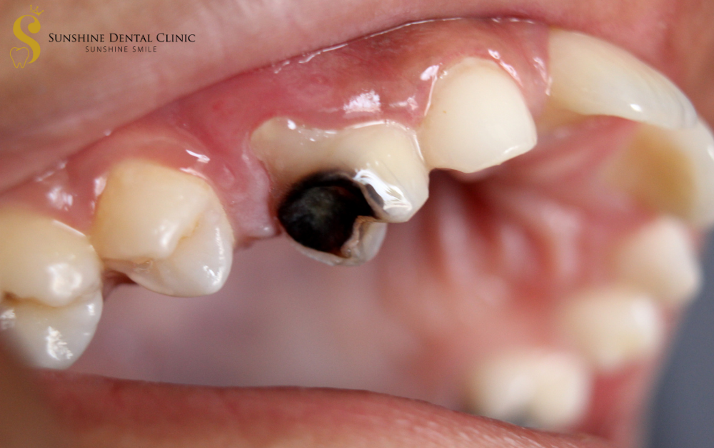  Dấu hiệu dễ quan sát nhất là những đốm màu nâu đen trên bề mặt răng