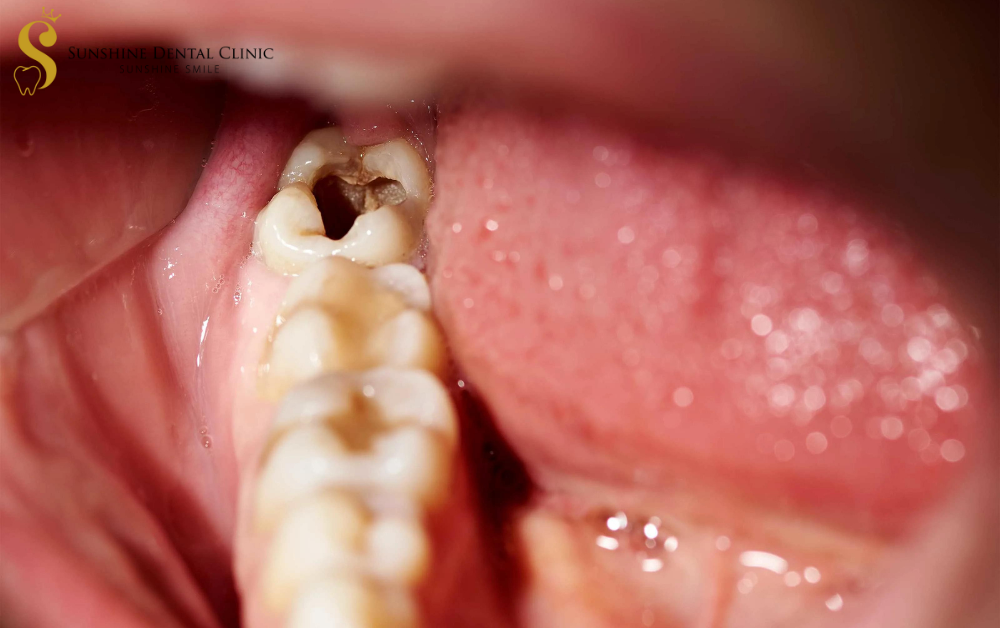 Sâu răng có thể gây ra những hậu quả nghiêm trọng
