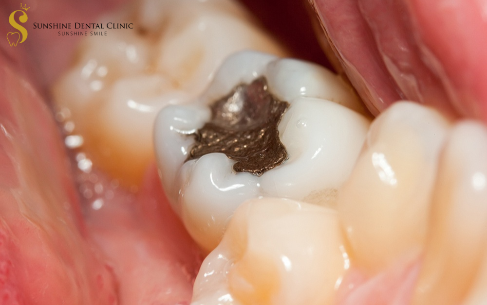 Phương pháp hàn trám khác phục tình trạng sâu răng