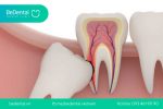 Răng khôn là gì? Nhổ răng khôn bao nhiêu tiền